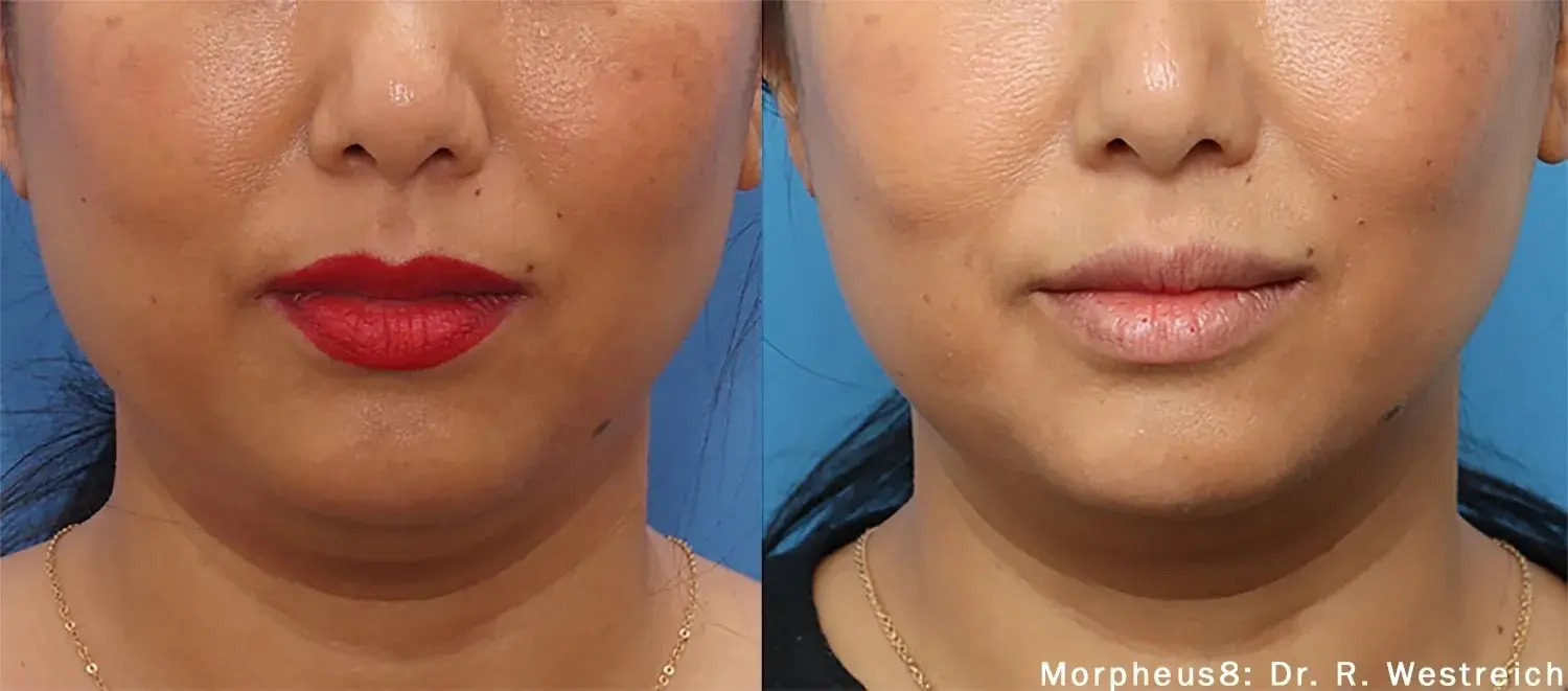 A before and after image of a woman with lesser fine lines and wrinkles