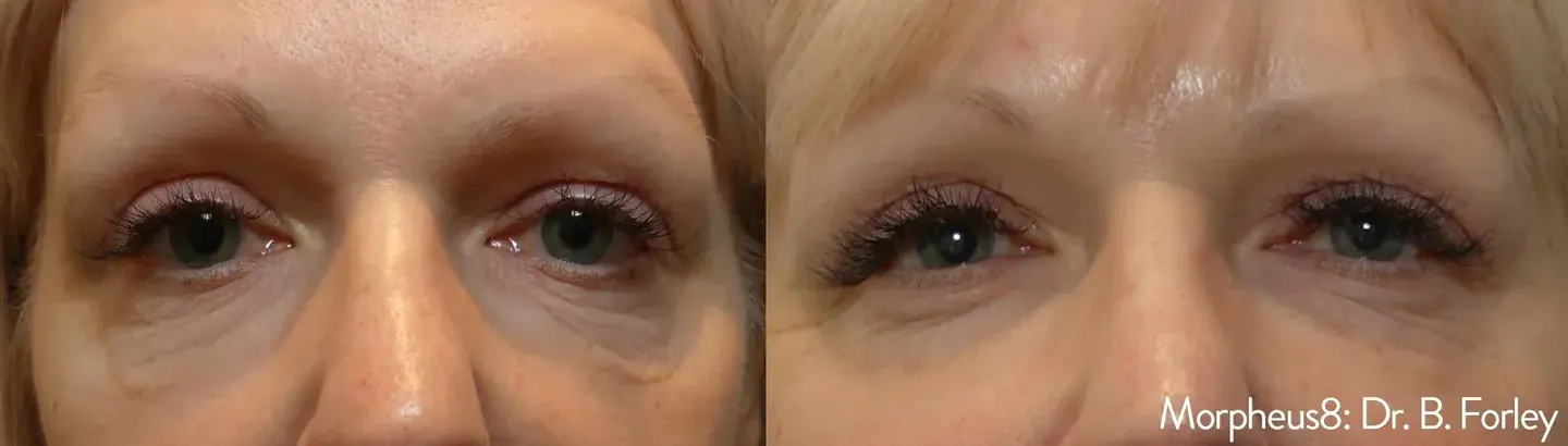 Before and after picture of a woman with tighter skin around her eyes