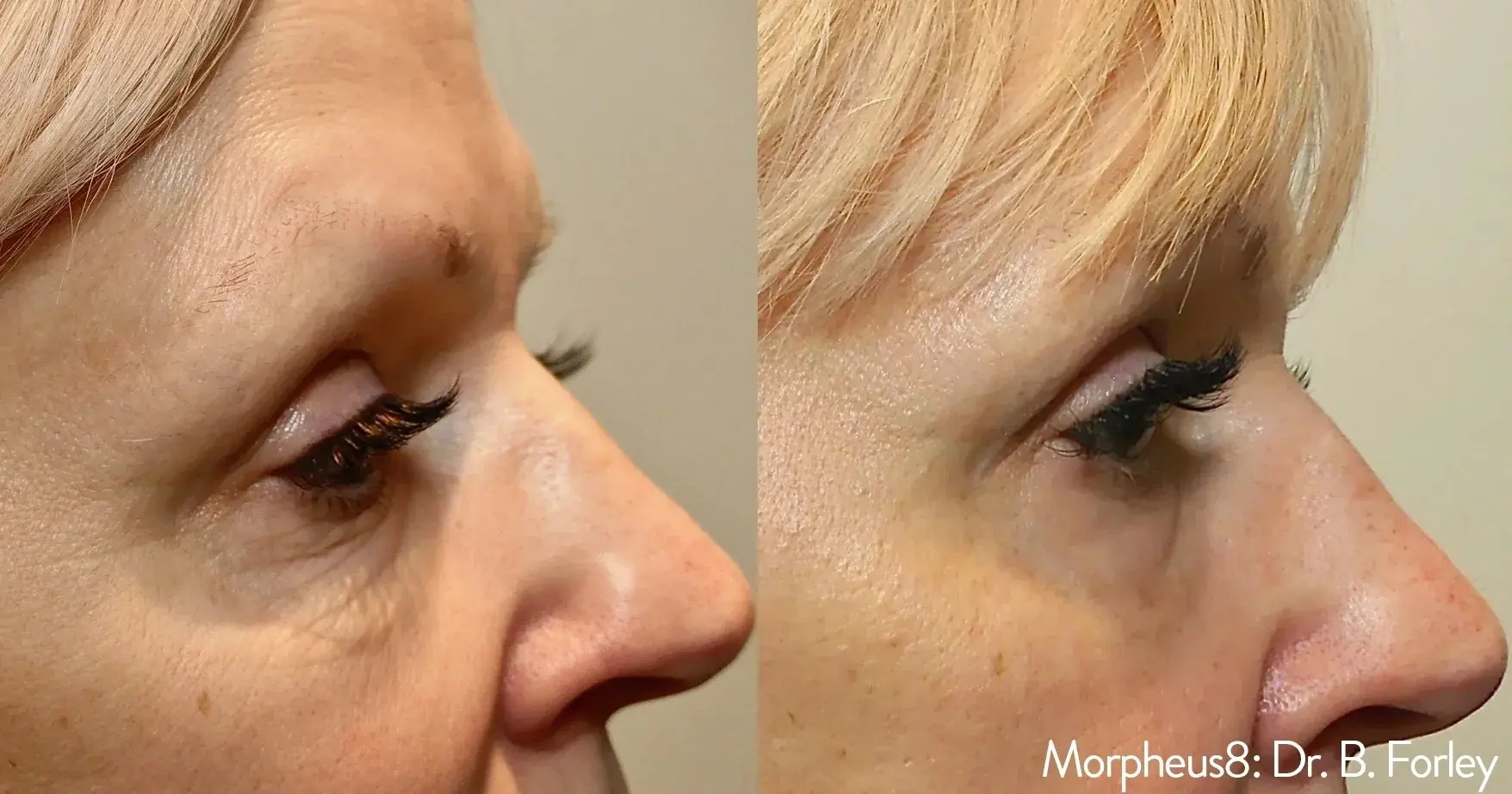 A before and after picture of a woman who had the skin under her eyes tightened