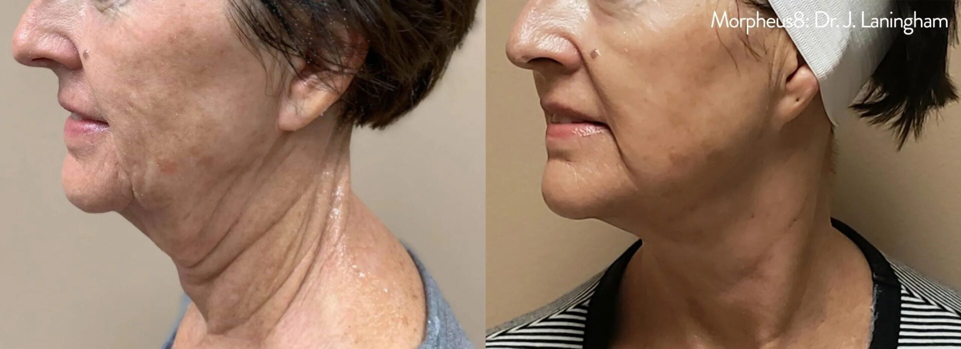 Before and after pictures of a woman who has tighter skin around her face and neck