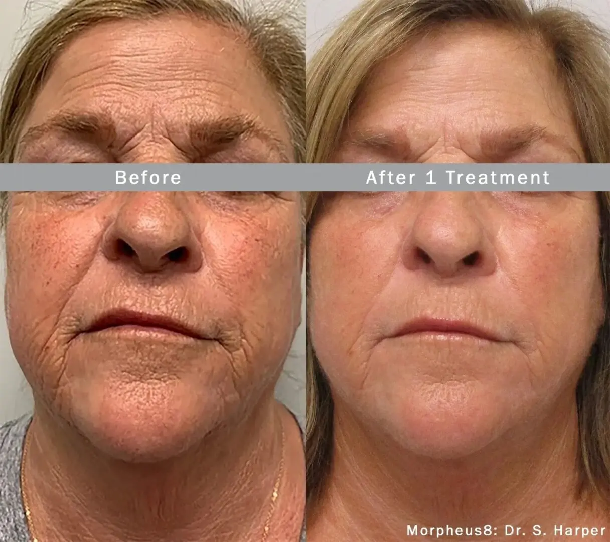 Before and after pictures under one treatment