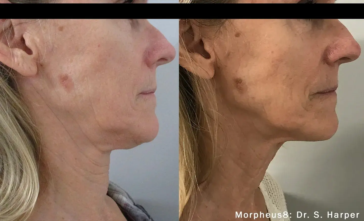 Before and after pictures of a woman after one treatment