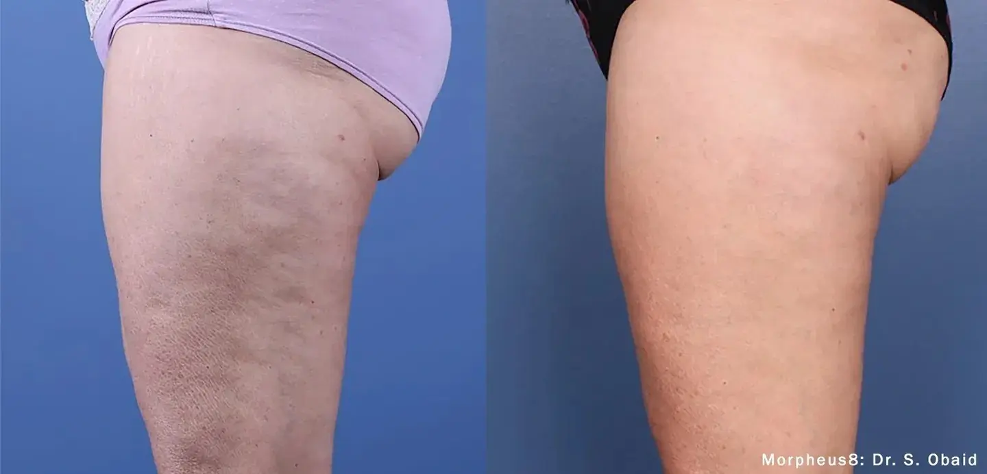 A before and after picture of a person’s thigh