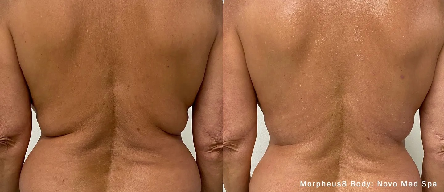 A before and after picture of a person’s back